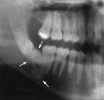 calcificatio