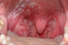 Lesioni Orali