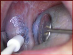 Prelievo con Punch Biopsy
