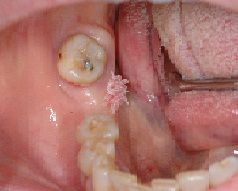 Lesione da HPV
