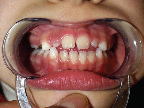 Open e interposizione della lingua in dentatura mista