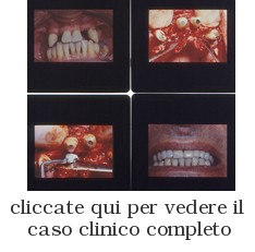 Diapositive di Interventi del Dr. Gustavo Petti: Parodontite Grave, Prima, Durante, Dopo la Terapia Parodontale Riabilitativa Completa e Complessa