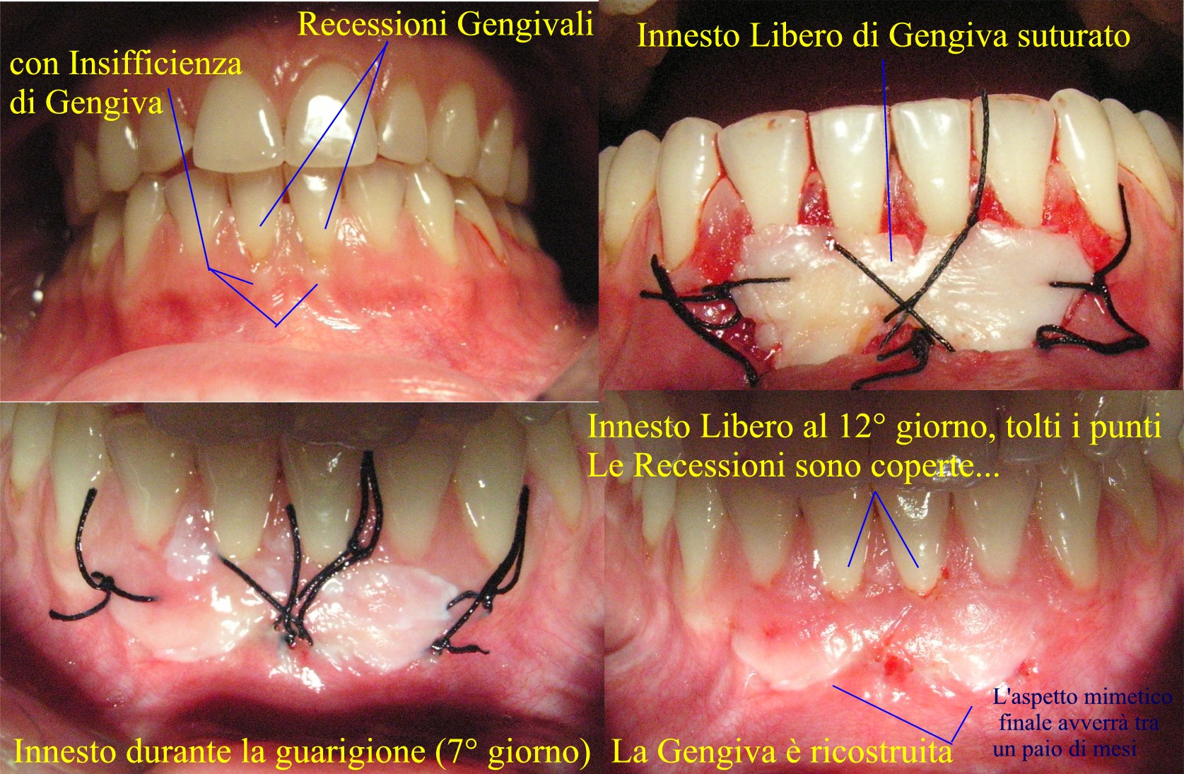 Recessioni Gengivali curate con innesto libero di gengiva, tra i tanti interventi a disposizione.Casistica Dr. Gustavo Petti di Cagliari