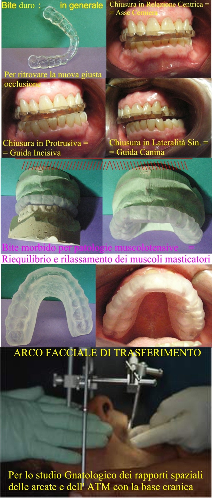 Bite ed Arco Facciale di Trasferimento. Dr. Gustavo Petti