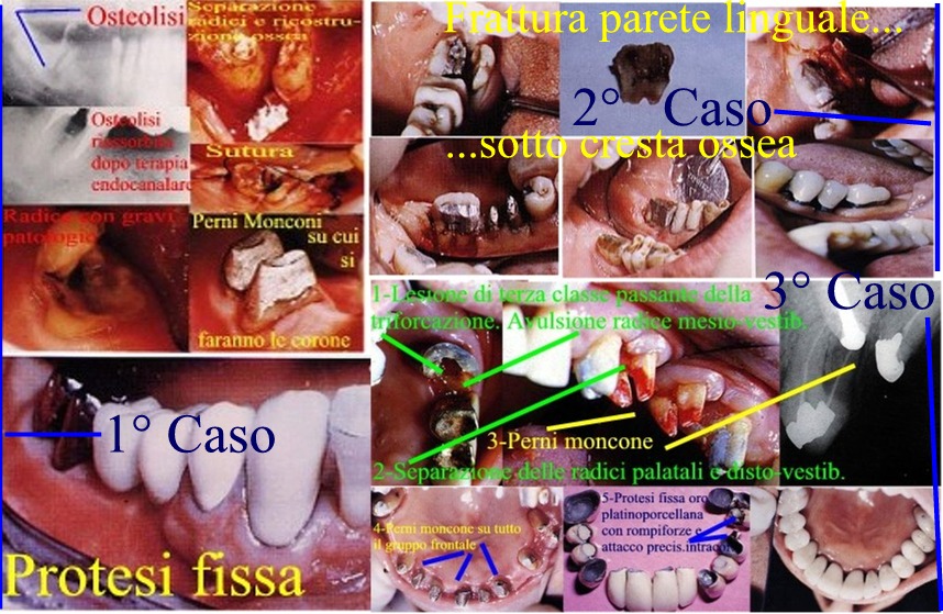 Fratture radicolari e coronali sotto gengiva e sotto cresta ossea salvati con la chirurgia parodontale e perni monconi.Da casistica della dr.ssa Claudia Petti e del Dr. Gustavo Petti di Cagliari