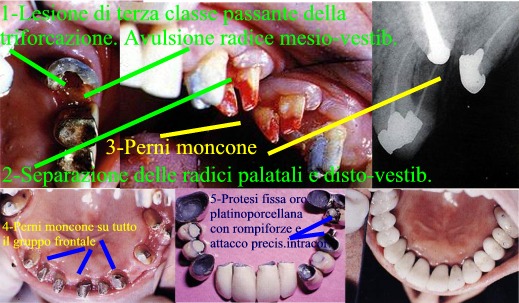 Terapia Radici fratturate in parodontiti. Da casistica del Dr. Gustavo Petti di Cagliari