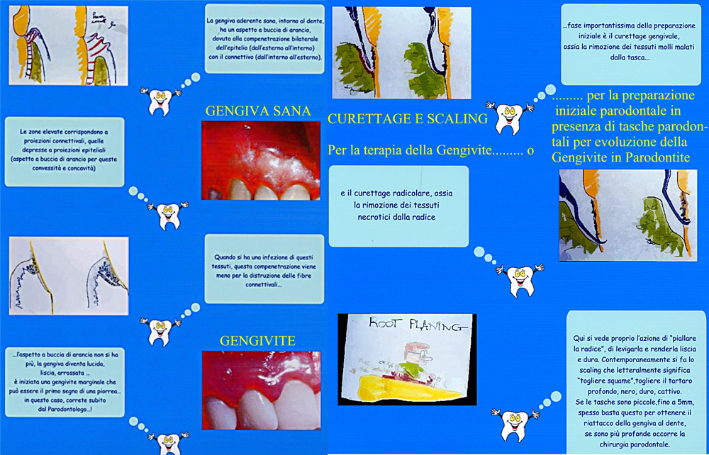 Gengivite. Spiegazione. Da Casistica del Dr. Gustavo Petti e della Dr.ssa Claudia Petti di Cagliari