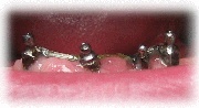 Barra elettrosaldata per overdenture (dentiera ancorata su impianti)