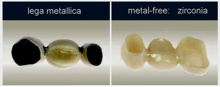 Risultati immagini per corone zirconio diffrenza  ceramica