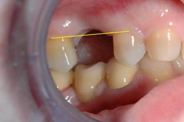 osso alveolare - foto 1
