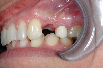 osso alveolare - foto 010