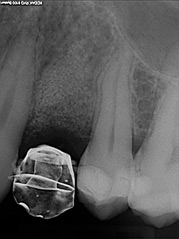 osso alveolare - foto 11