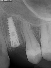 osso alveolare - foto 12