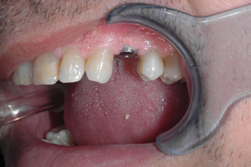 osso alveolare - foto 13
