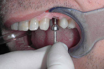 osso alveolare - foto 14