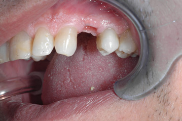 osso alveolare - foto 15