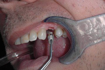 osso alveolare - foto 16