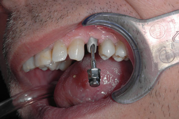 osso alveolare - foto 17
