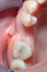 osso alveolare - foto 2