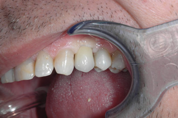 osso alveolare - foto 20