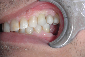 osso alveolare - foto 21