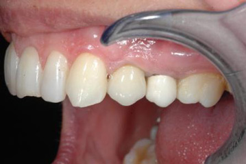 osso alveolare - foto 22