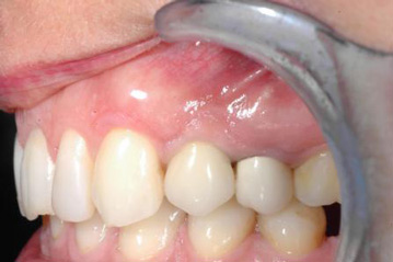 osso alveolare - foto 23