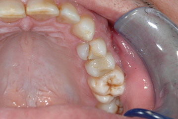 osso alveolare - foto 3