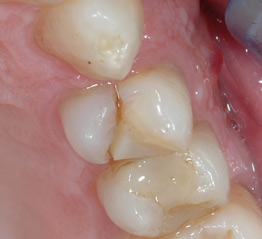osso alveolare - foto 4