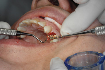 osso alveolare - foto 5