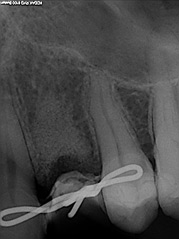 osso alveolare - foto 6