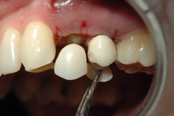 osso alveolare - foto 8