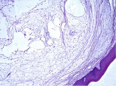 neurotecheoma della lingua