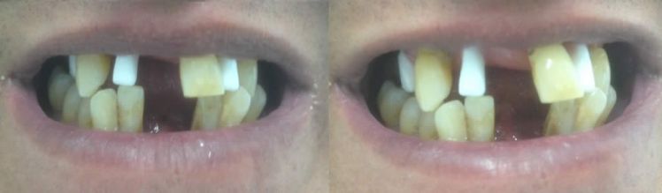 Dima radiologica con denti in solfato di bario