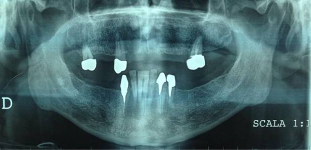 overdenture inferiore con impianti su protesi combinata