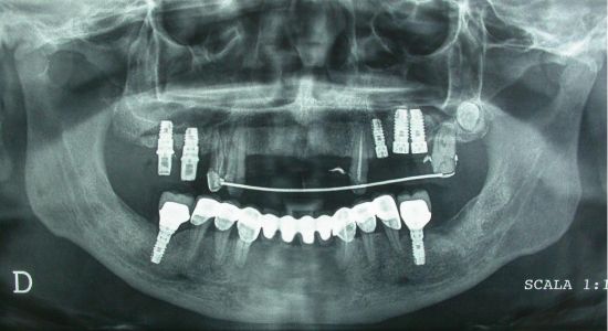 riabilitazione implantare in paziente cardiopatico