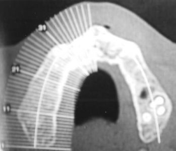 riabilitazione implantare in paziente cardiopatico