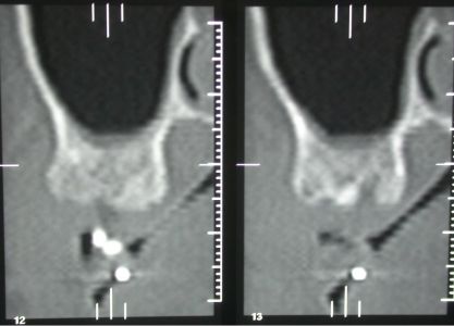 riabilitazione implantare in paziente cardiopatico