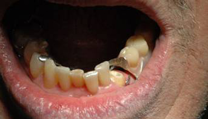 dente spezzato