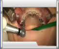 Video Implantologia Dr. Deodato - 03