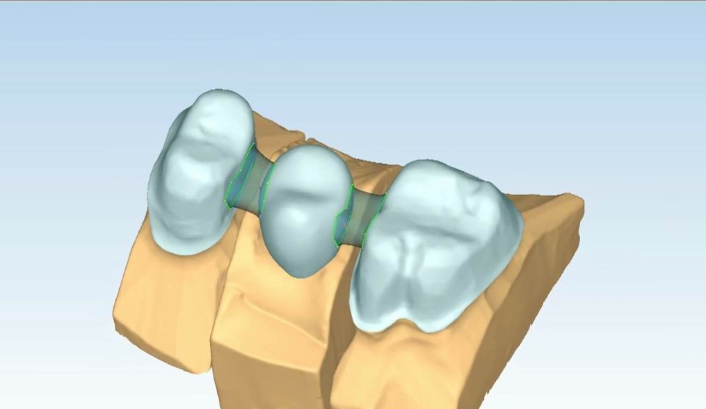 Protesi Fissa in Zirconio - Cad Cam Tecnologies