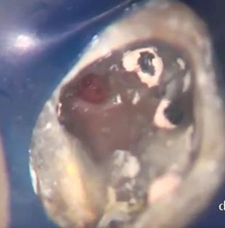 Chiusura di una perforazione sul pavimento di un molare superiore