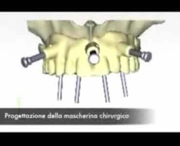 All on 4 - Implantologia a carico immediato