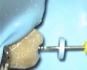 Endodonzia con strumenti reciprocanti e laser assistita