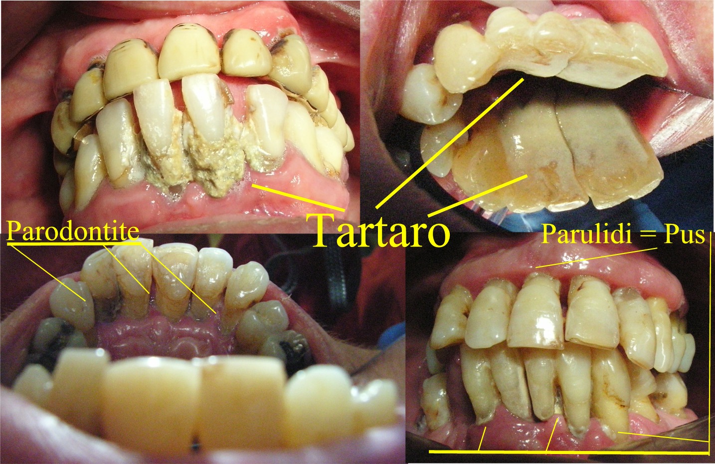Parodontite (nozioni di etiopatogenesi, clinica, diagnosi)