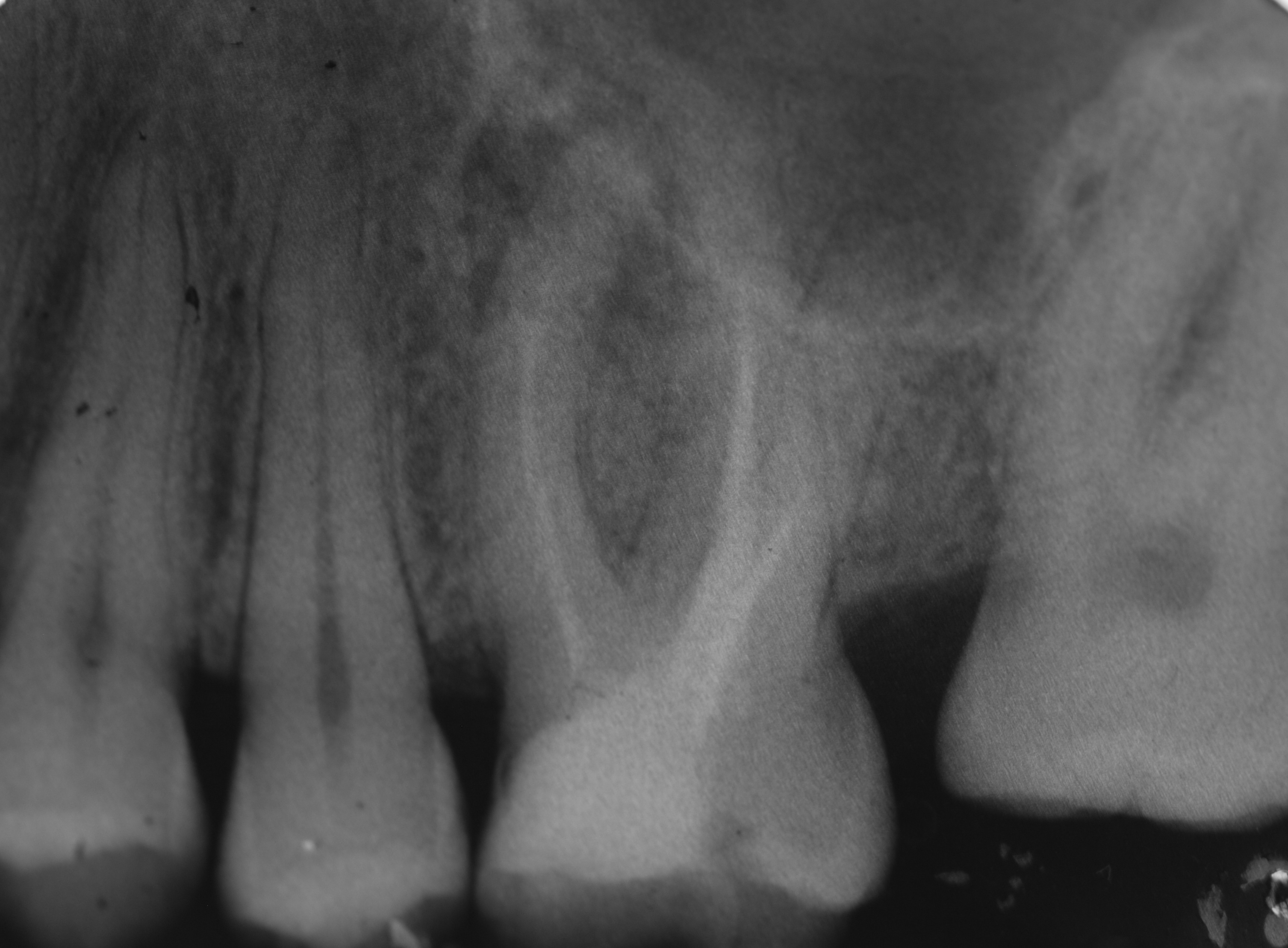 Che cos' e' il cosiddetto 'granuloma'