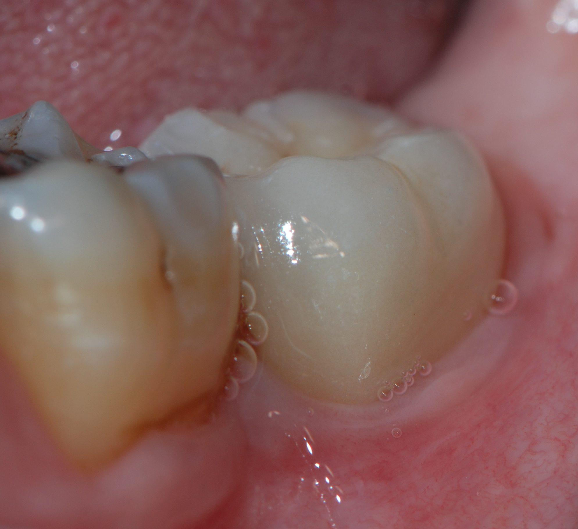 Protesi in Zirconia: futuro tra estetica e biocompatibilità