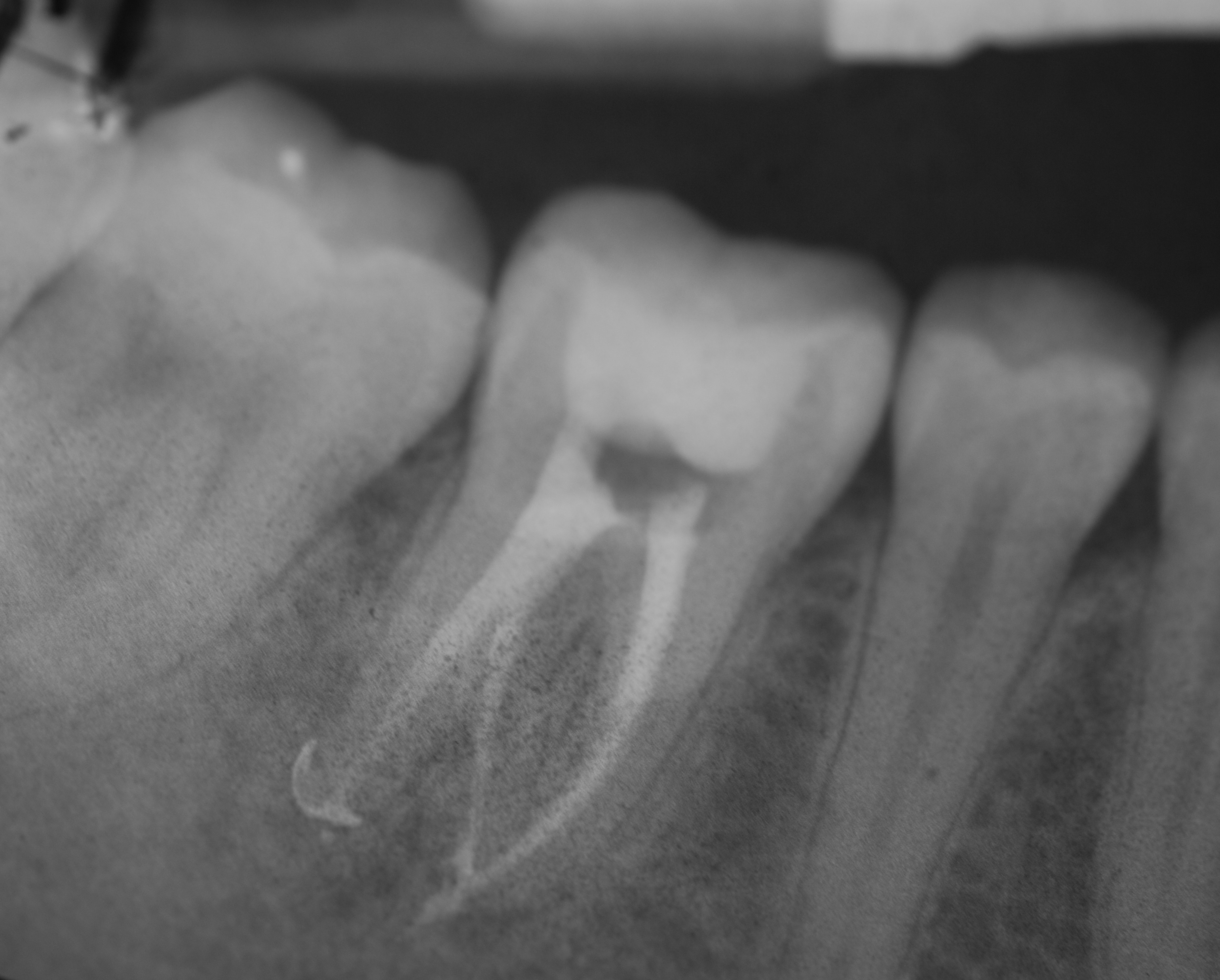 IV canale: causa di fallimento nella terapia endodontica