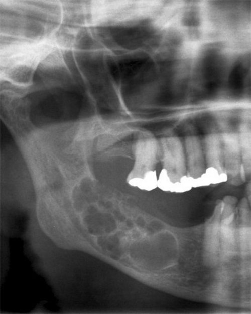 Ameloblastoma