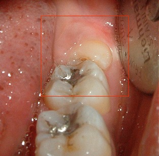 Disodontiasi del terzo molare